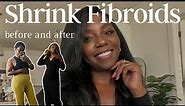 shrink fibroids naturally | stop hair loss | heal your womb