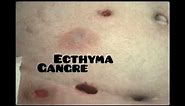 ecthyma (causes, symptoms and treatment )|dermatology|skin disease