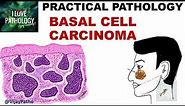 BASAL CELL CARCINOMA: Clinical features & Morphology