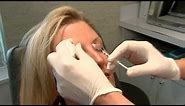 More Women in Their 20s Use Botox