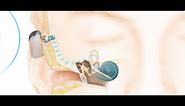How the Cochlear™ Baha® Connect System Works