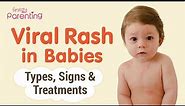 Common Viral Rashes in Babies - Types, Signs and Treatement