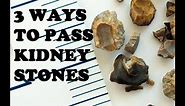3 Ways To Pass Kidney Stones