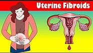 Uterine Fibroids Signs And Symptoms Types, Causes, And Treatment