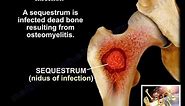 Osteomyelitis Bone Infection - Everything You Need To Know - Dr. Nabil Ebraheim