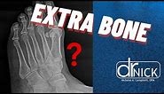 Extra bone in your foot? The accessory navicular bone | Dr. Nick