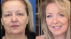 57-Year-Old Has a COMPLETE Facelift Transformation!