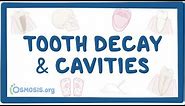 Tooth decay and cavities - causes, symptoms, diagnosis, treatment, pathology