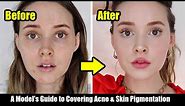 How I Cover My Acne, Acne Scars, & Skin Pigmentation | A Model's Tips *Easy, Non-Cakey*