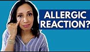 Allergic Reaction to Eye Makeup | Eye Doctor Explains