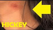 how to give someone a hickey on the neck easy
