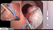 Colonoscopy with polypectomy procedure overview using Olympus devices