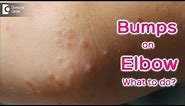 Small raised bumps on elbow - Causes & Treatment - Dr. Rajdeep Mysore