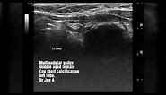 Multinodular goiter thyroid + eggshell calcification ultrasound video
