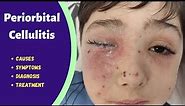 Eyelid infection | Periorbital cellulitis