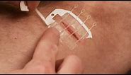 Treating a wound with ZipStitch