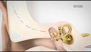 VIBRANT SOUNDBRIDGE Middle Ear Implant System for Hearing Loss Video | MED-EL USA