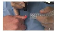 The power of Laser: Periungual warts... - Dr. Asif Hussein