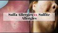 Sulfa Allergies vs Sulfite Allergies