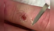 Wart Removal by Radiosurgery - Quick & Thorough Removal of Stubborn Finger Warts!