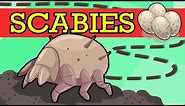 SCABIES, Causes, Signs and Symptoms, Diagnosis and Treatment.