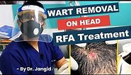 Wart Removal on Head | Live RFA Wart Removal Treatment | Dr Jangid