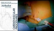 Tunneled Dialysis Catheter (Alan B. Lumsden, MD, Philip Auyang, MD)