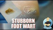 HOW TO TREAT DIFFICULT PLANTAR WARTS REMOVAL - FOOT HEALTH MONTH 2018 #9