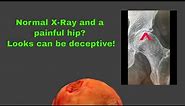 Painful hip and a 'normal' X-Ray? Looks can be deceptive....
