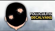 Folliculitis Decalvans: What You Need To Know