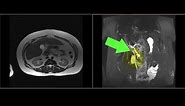 Gallbladder - Normal Anatomy - MRI Online