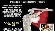 Subscapularis Muscle Tear A Hidden Lesion - Everything You Need To Know - Dr. Nabil Ebraheim