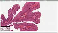Squamous Papilloma - Larynx - Histopathology