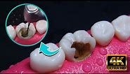 INCREIBLE reconstrucción de diente dañado por caries: Endodoncia en 4K