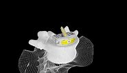 The CoreLink M3 Stand-alone ALIF System features a versatile, three-screw design that incorporates the biocompatible benefits of Mimetic Metal along with a comprehensive array of straight and angled instruments. Learn more at https://corelinksurgical.com