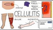 Understanding Cellulitis: Skin and Soft Tissue Infections