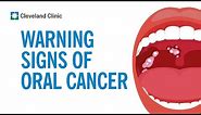 How to Screen Yourself for Oral Cancer