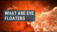 What Are Eye Floaters