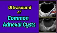 Ultrasound of Common Adnexal Cysts