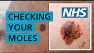 How do I check if my mole is skin cancer? | NHS