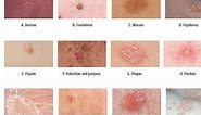 Skin Lesions with defination
