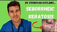 Explaining Seborrheic Keratosis | With Dr O'Donovan
