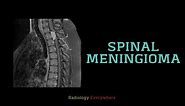 Spinal Meningioma Radiology Tutorials #radiology