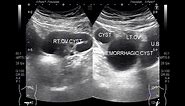 Ultrasound Video showing Ovarian Cysts, simple, Hemorrhagic and complex ones, all in one patient.