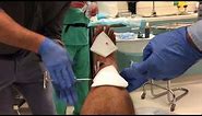 Severe Open Compound Fracture Fib-Tib External Fixator (Ex-Fix) Removal w/out Anesthetics
