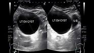 Ultrasound Video showing a Large Ovarian Cyst.