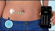 What is Continuous Glucose Monitoring (CGM)