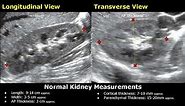 How To Measure Kidney On Ultrasound | Renal Length, Width, AP Thickness & Volume Measurements USG