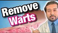 Wart Removal 101 | How to Get Rid of Warts