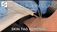 Skin Tag Removal | Watch the Procedure